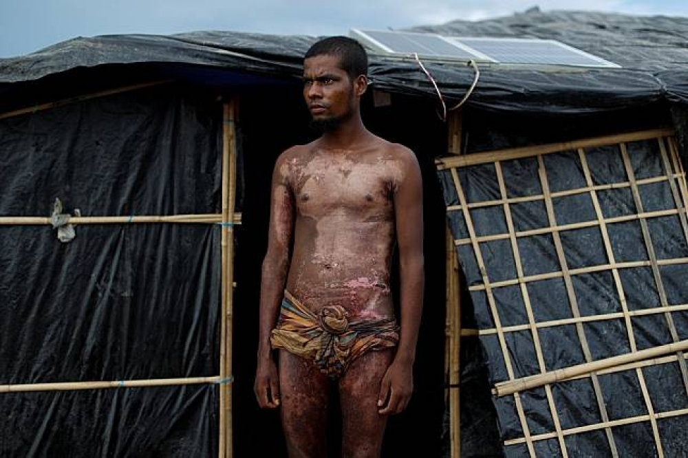 身上燒傷疤痕清晰可見的羅興亞難民。（湯森路透）