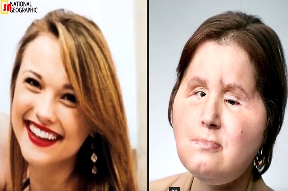 美國22歲的女子史特柏菲爾德（Katie Stubblefield），為全美最年輕的臉部移植手術患者。（翻攝自Youtube）
