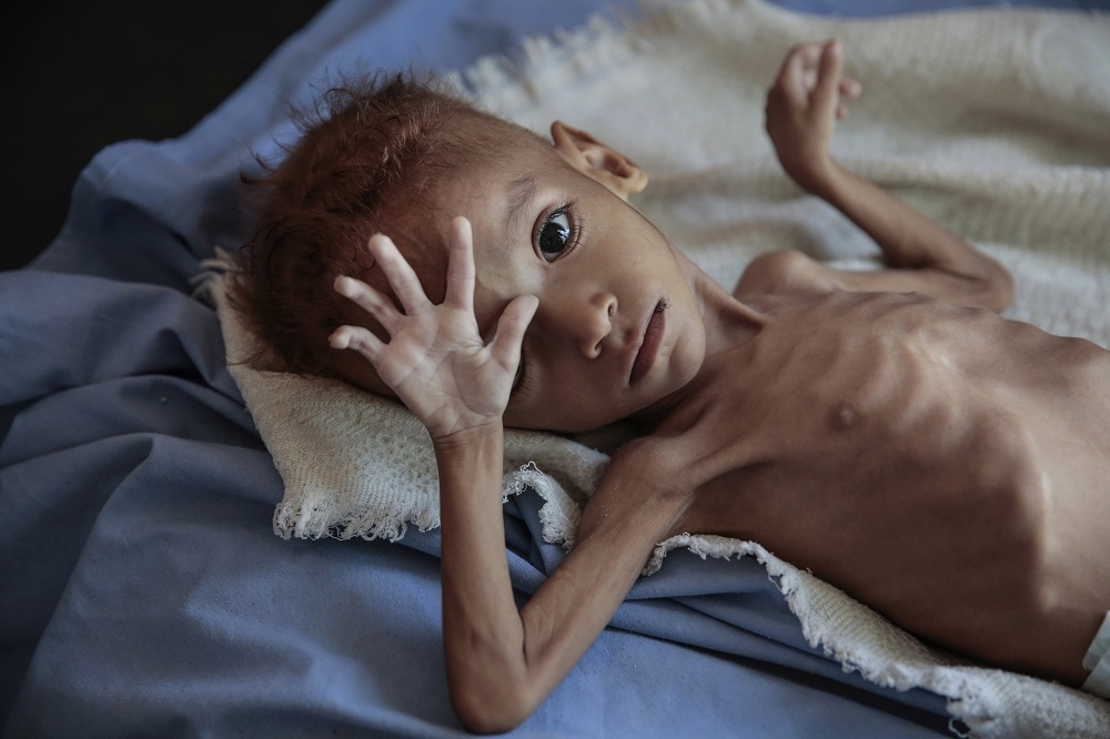 人道組織估計，葉門內戰中超過8萬兒童因為營養不良喪生。（美聯社）