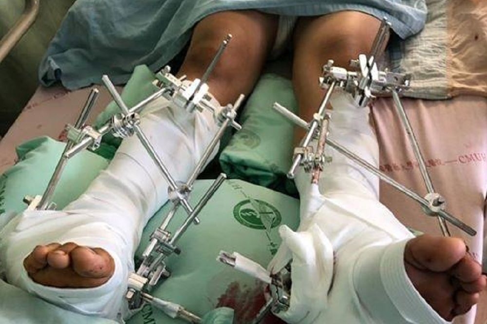 台中市一名國三生遭霸凌而跳樓，導致雙腿開放性骨折，目前仍住院救治中。（圖片取自爆料公社）