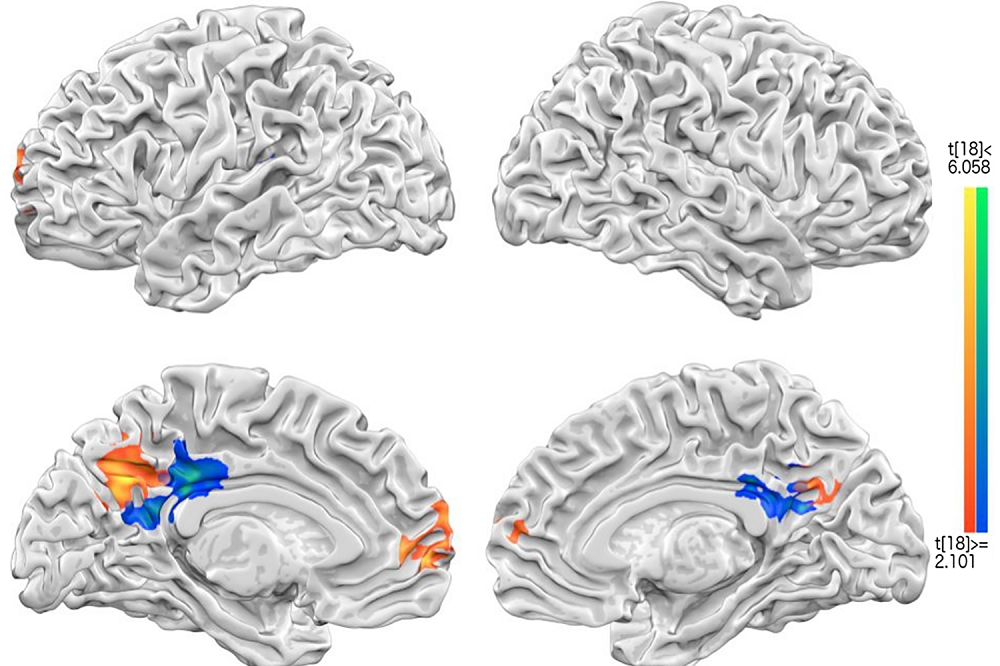 成功大學透過磁振造影儀（MRI）進行大腦造影，讓幸福能在大腦中被看見，研究成果今年10月發表於《PLOS ONE》期刊。（取自PLOS ONE期刊網頁）