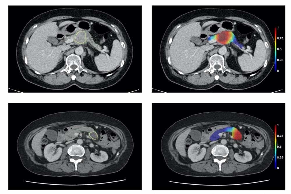 左側黃色與綠色標示者分別為腫瘤與胰臟，右側紅色區域為人工智慧分類模型預測的腫瘤 。（取自《The Lancet Digital Health》期刊）