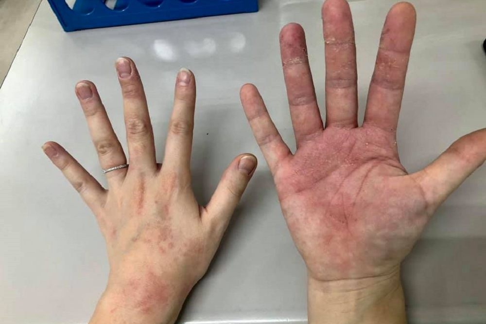 羅姓護理長貼出護理師雙手因長期帶著手套、酒精消毒而破皮起疹照片，令人心疼。（羅姓護理長提供）