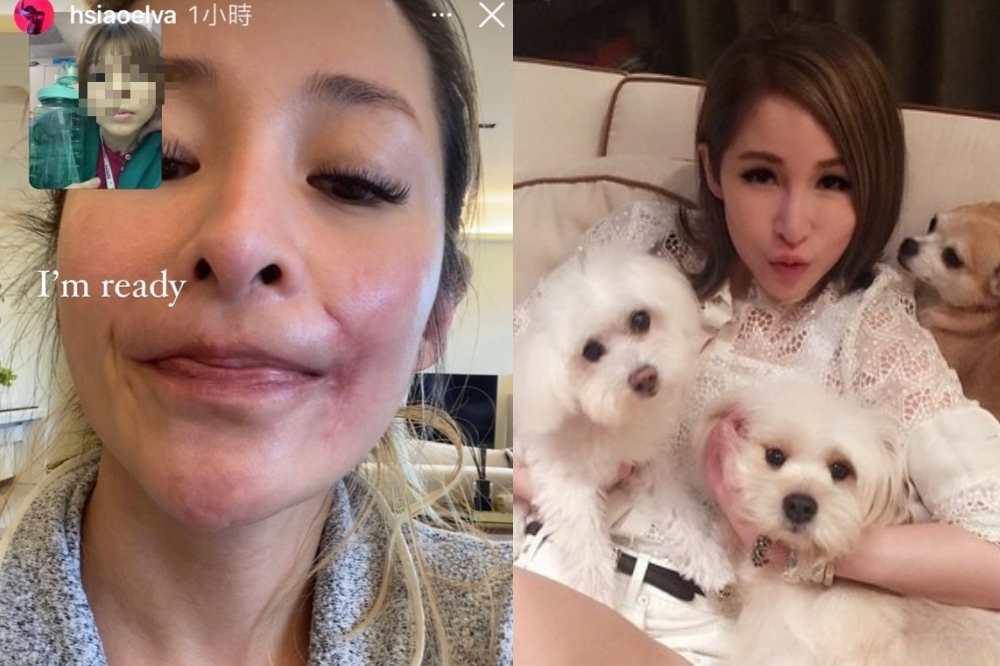 蕭亞軒之前傳在家中被愛犬咬傷臉嚴重到住院1個多月，今(12日）她在IG上曝光驚人疤痕。（取自蕭亞軒IG限動）