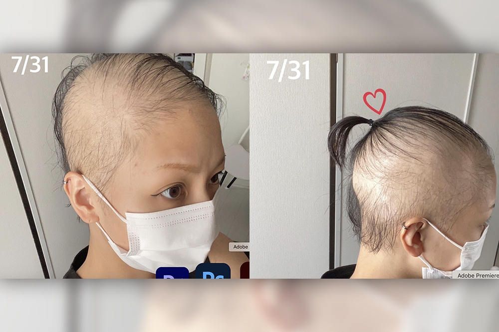日本近日有一名女子在接種莫德納疫苗後出現不停掉髮的狀況。（擷自ameblo網站）