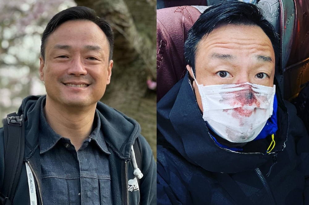 港星王喜3日晚間入境台灣，在進行機場PCR採檢時，鼻子被捅傷噴血，暴怒連發數篇臉書想找出弄傷他的採檢人員。（取自王喜臉書）