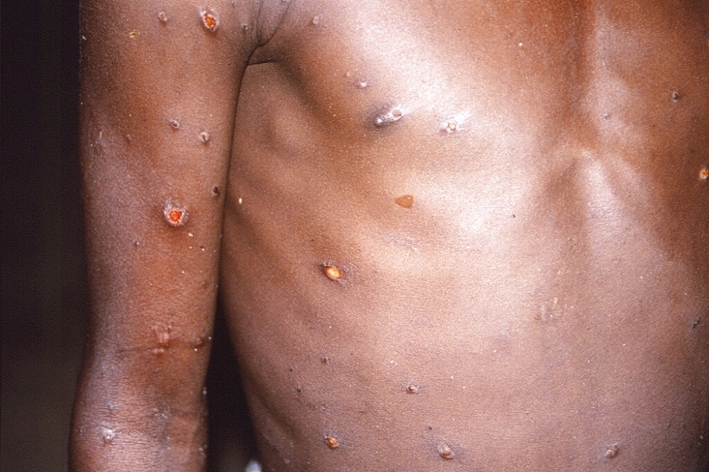 英國傳出猴痘的社區傳染。（美聯社）
