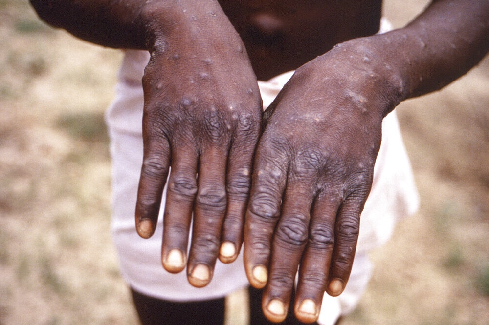 非洲以外爆發猴痘疫情國家已增至21國。（美聯社）