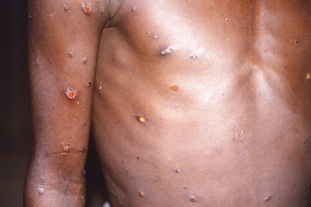 非洲以外地區近期爆發猴痘疫情。（美聯社）