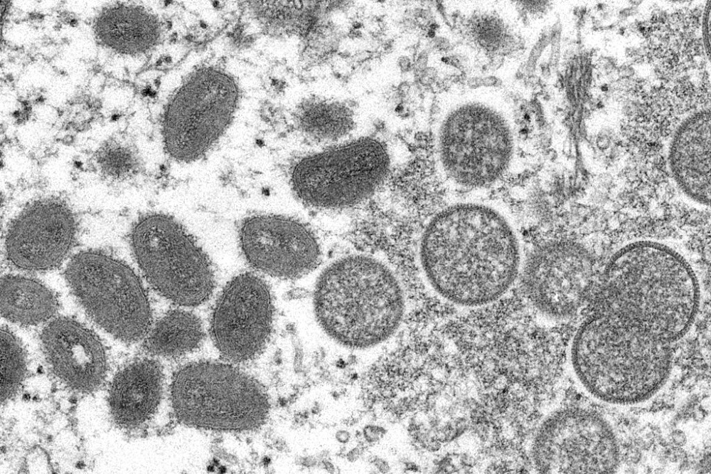 猴痘病毒在顯微鏡下的模樣。（美聯社）