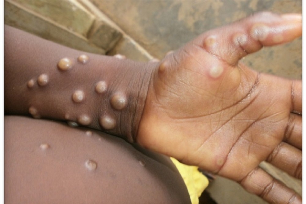 猴痘患者會出現發燒、身體疼痛、發冷和疲勞；臉部和手出現水泡，而且可能擴散到身體其他部位。（圖片來源：奈及利亞疾管局）