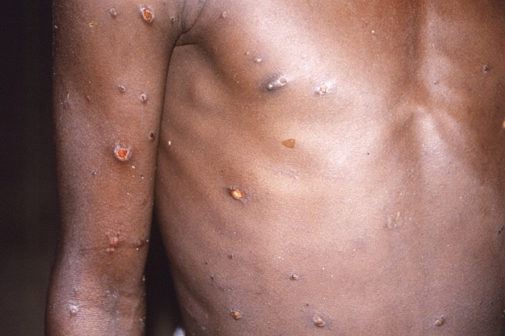 猴痘疫情出現於亞洲2國家，對此，我國疾管署指出，最快23日將猴痘列為第二類法定傳染病。（資料照片／美聯社）