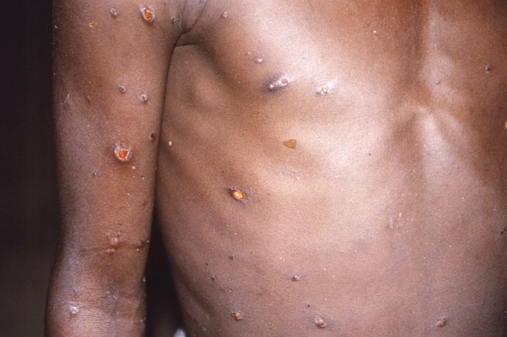 感染猴痘的人通常在接觸感染後6至13天開始出現症狀。（美聯社）