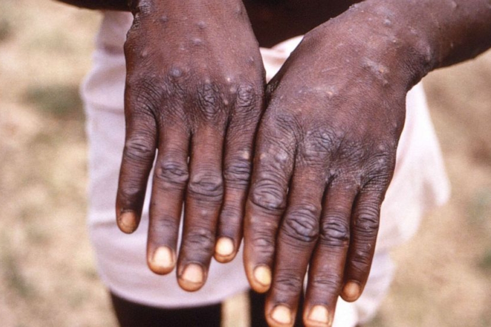 感染猴痘病毒后，皮肤通常会起疹、长水泡（美联社）(photo:UpMedia)