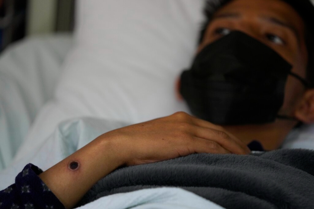 祕魯一名猴痘患者住院接受治療，手上皰瘡清楚可見。（美聯社）