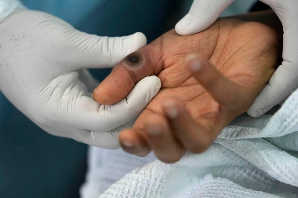 猴痘患者手部出現皮膚病變。（美聯社）