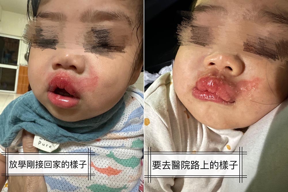 高雄一名1歲女童在托嬰中心喝奶時，疑似遭高溫奶水燙傷嘴巴。（取自爆廢公社公開版）
