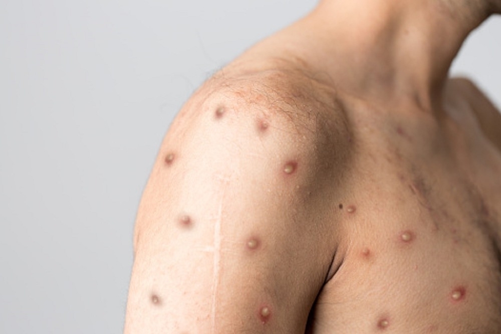 疾管署公布，國內又增14例確診猴痘，皆是男性，全國北中南都有個案。僅為示意圖。（取自pixabay）