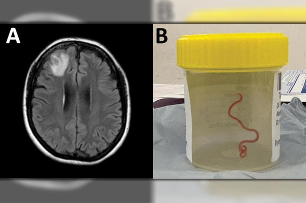 澳洲坎培拉醫院發現一名患者腦內有異（左）後，竟開刀取出一條長8公分的蛇蛔蟲（右）。（取自美國CDC官網）
