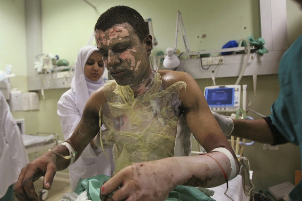 人權組織指控以色列軍方使用備受爭議的白磷彈藥，圖為2009年1名巴勒斯坦民眾，在加薩遭以軍使用該款彈藥攻擊燒傷的情形。（美聯社）