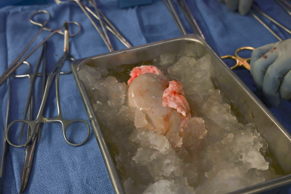 美國麻省總醫院的醫療團隊成功將經過基改的豬腎臟，移植至1名腎病患者身上。（美聯社）